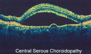 Macular Pucker Treatment | Fluorescein Angiography | OCT Imaging ...